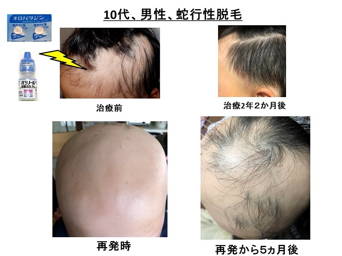 円形脱毛症　病院